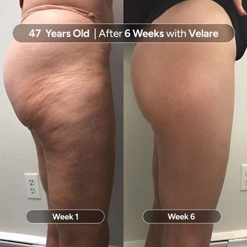 Kollagen + Stammzellen Cellulite Öl